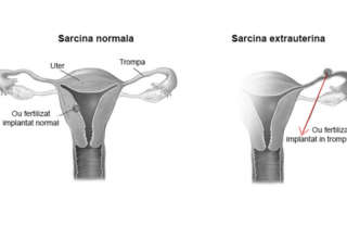 Sarcina extrauterina - ectopica